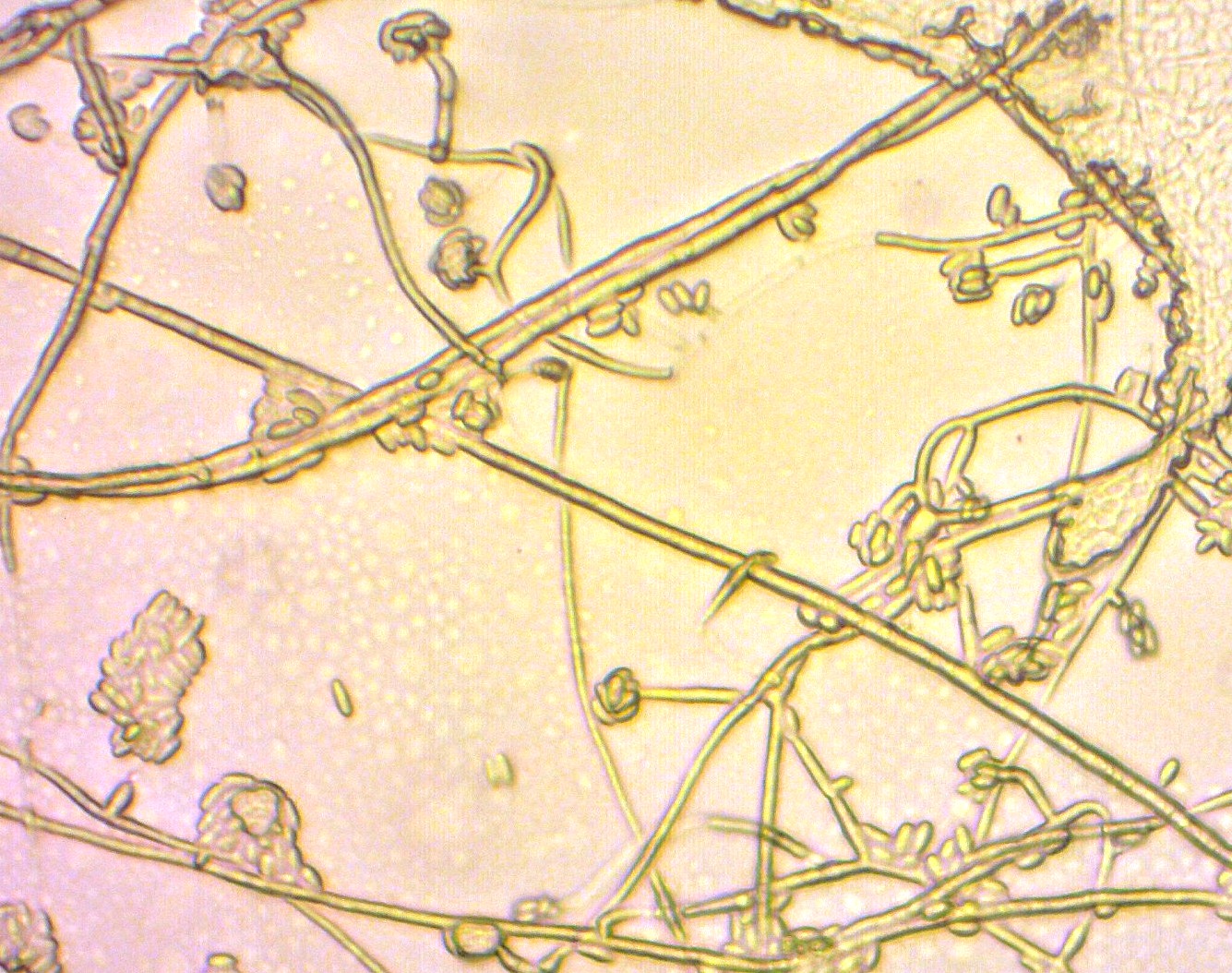 Caso clinico 1: Caratteristiche microscopiche di  F. oxysporum - ife sottili, ialine e settate, con conidiofori portanti microconidi piccoli e ovali, a 1-2 cellule, isolate o raggruppati in piccoli clusters (microscopio ottico, 40X)
